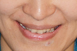 proimages/case06/case06-14/矯正前.jpg proimages/case06/case06-14/矯正前.jpg