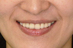 proimages/case06/case06-14/矯正後.jpg proimages/case06/case06-14/矯正後.jpg