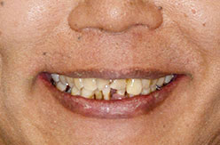 proimages/case06/case06-15/矯正前.jpg proimages/case06/case06-15/矯正前.jpg