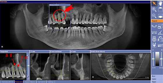 竹北植牙 竹北植牙