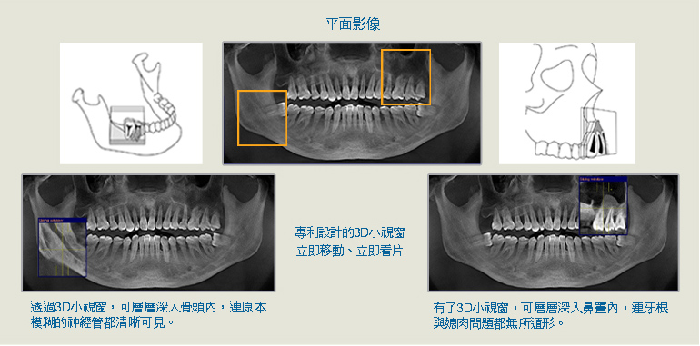植牙3D電腦斷層 植牙3D電腦斷層