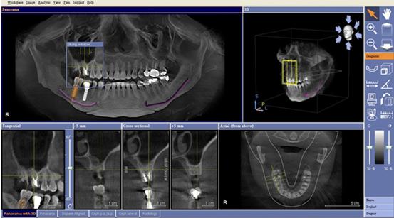 竹北植牙 竹北植牙
