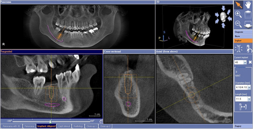 竹北植牙 竹北植牙