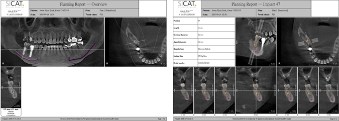 竹北植牙 竹北植牙