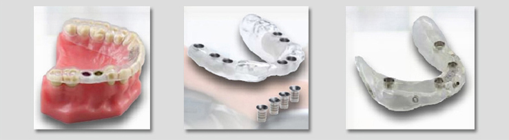 3D植牙-手術導板定位