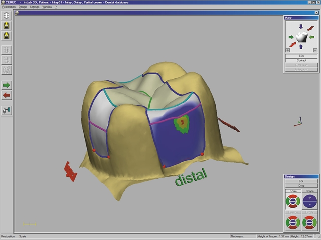 本院全新引進CEREC 3D齒雕機。