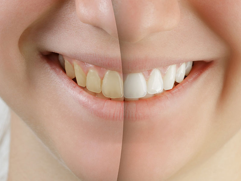 牙齒美白